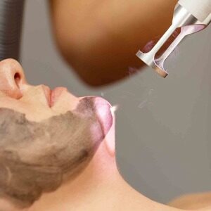 Carbon Laser Treatment