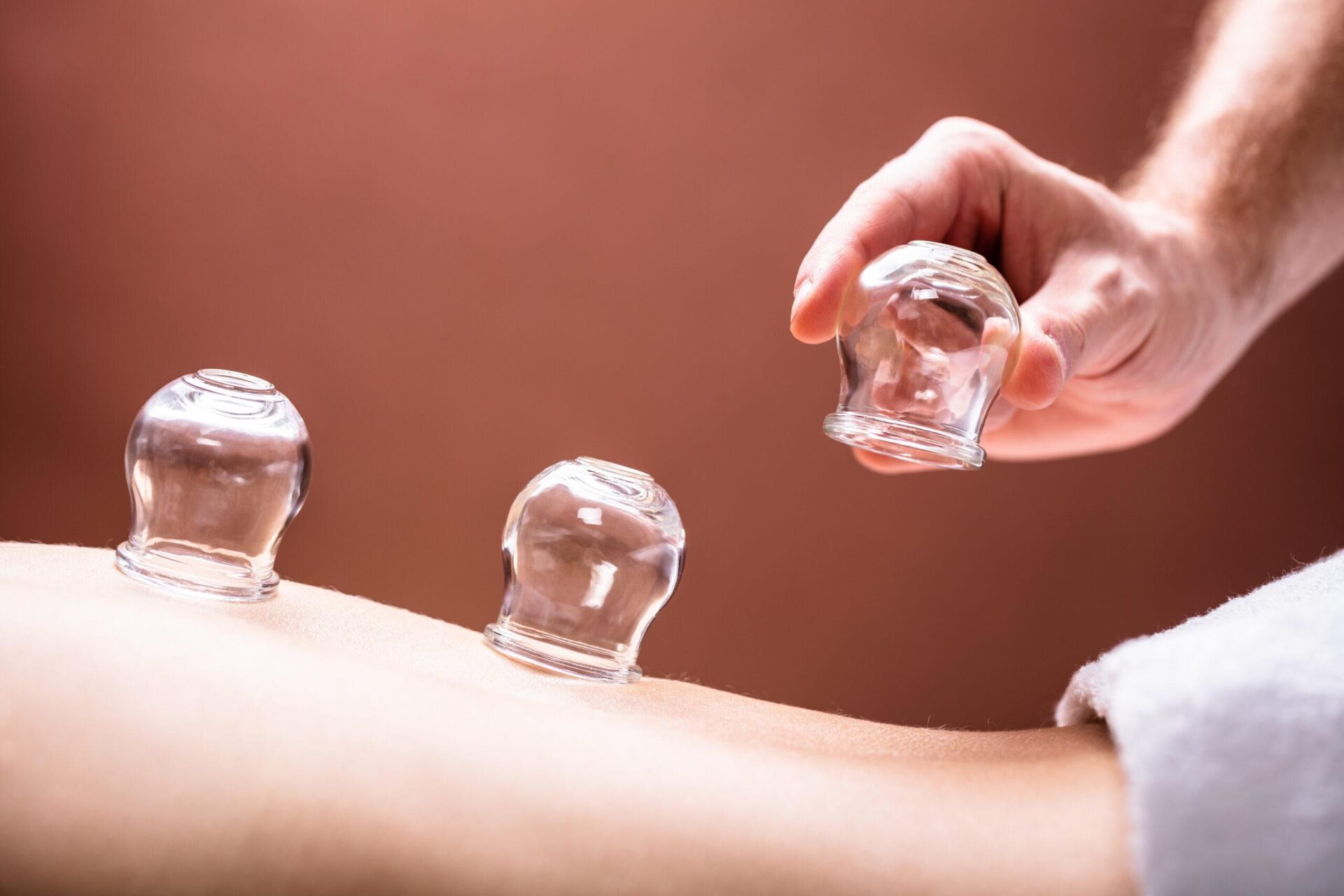 hijama cupping