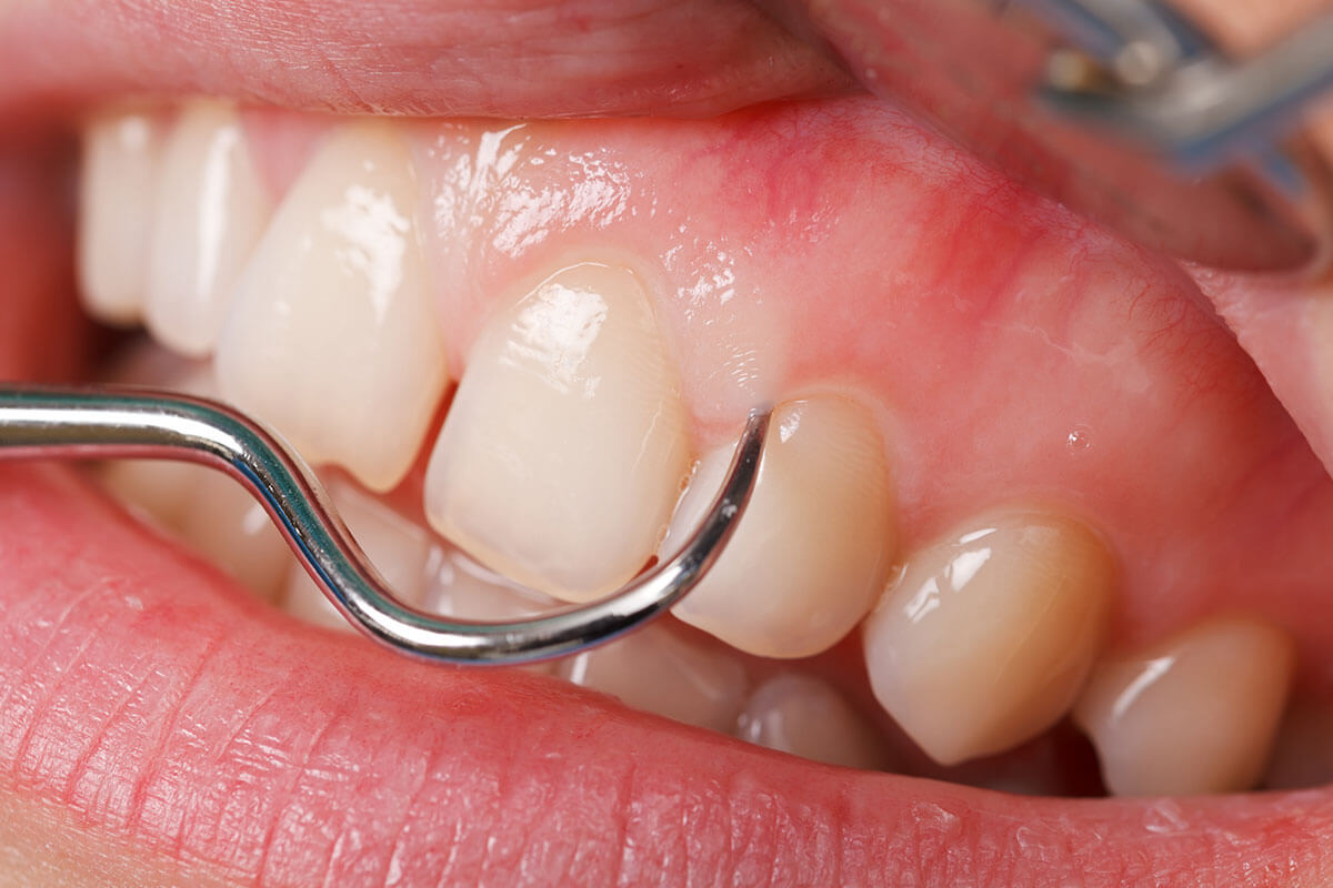 teeth scaling and root planning