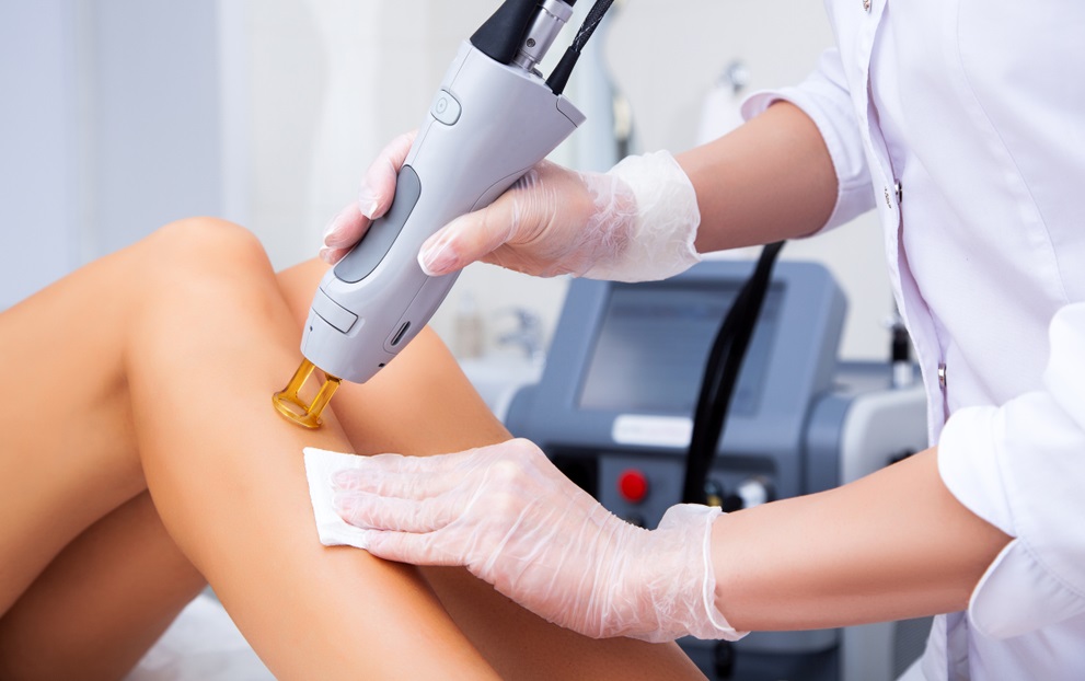 laser hair removal