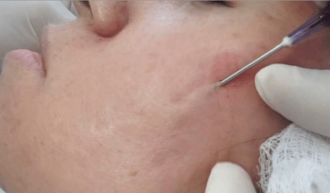 subcision acne scars treatment