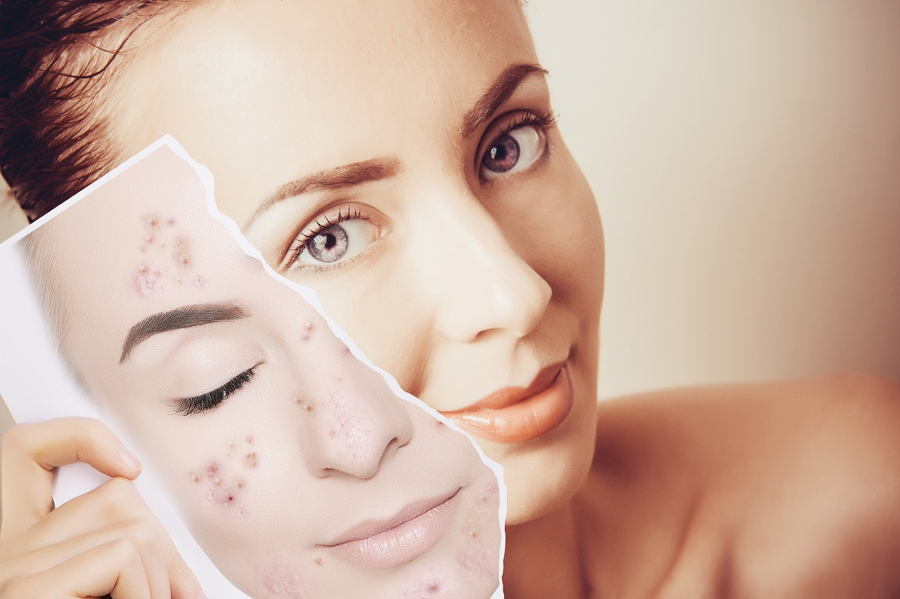 Dermatologist for Acne and scars Treatment