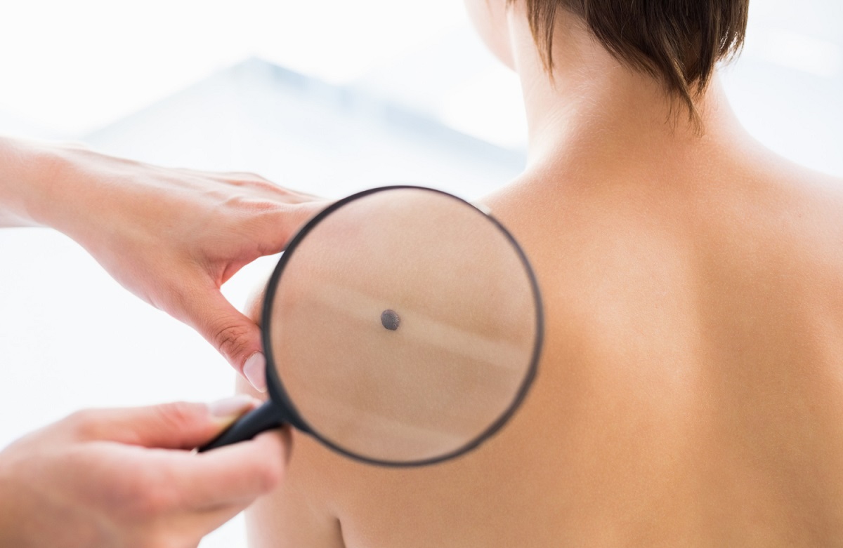 removal of skin tags